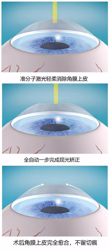 SMART全激光手术价格,手术怎么做的?